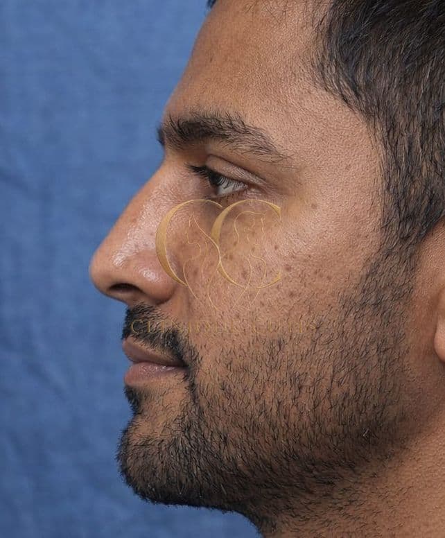 Rhinoplasty After