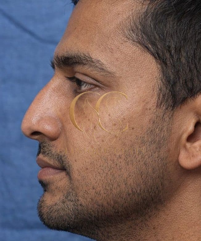 Rhinoplasty Before