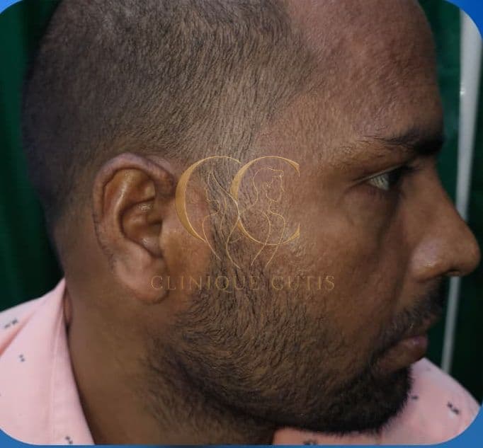 Ear Keloid After