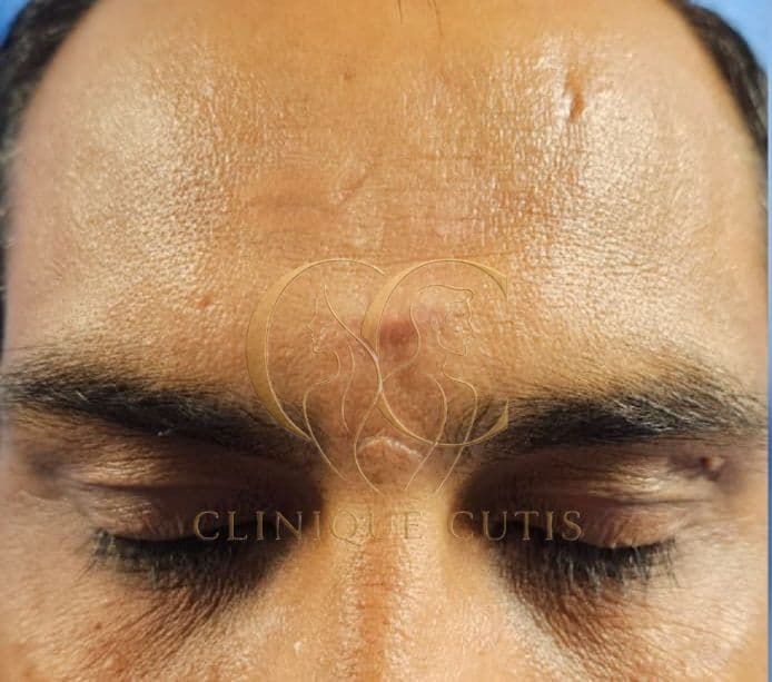 Sebaceous Cyst After
