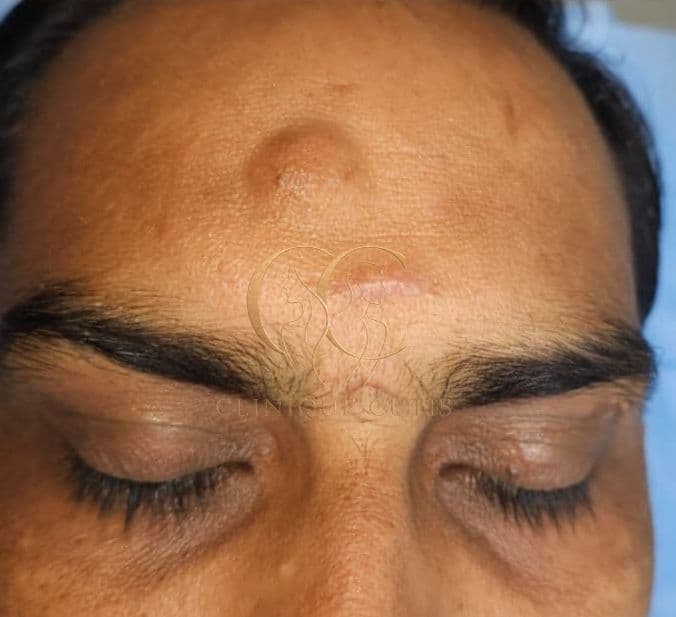 Sebaceous Cyst Before