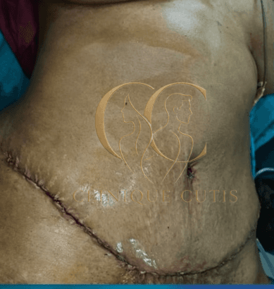 Tummy Tuck After