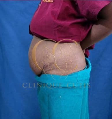 Tummy Tuck Before