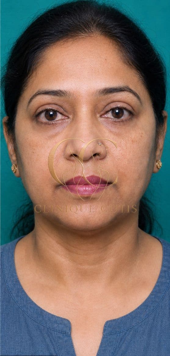 Upper Blepharoplasty After