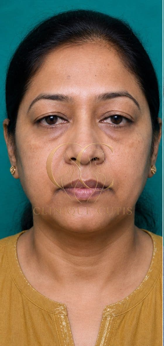 Upper Blepharoplasty Before