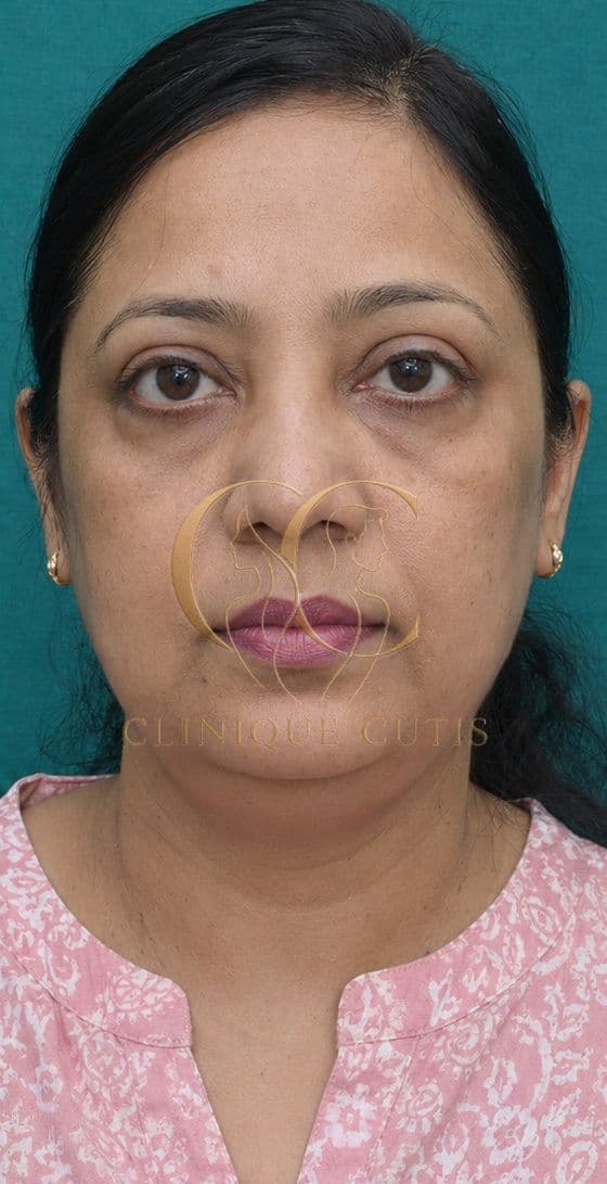 Upper Blepharoplasty After