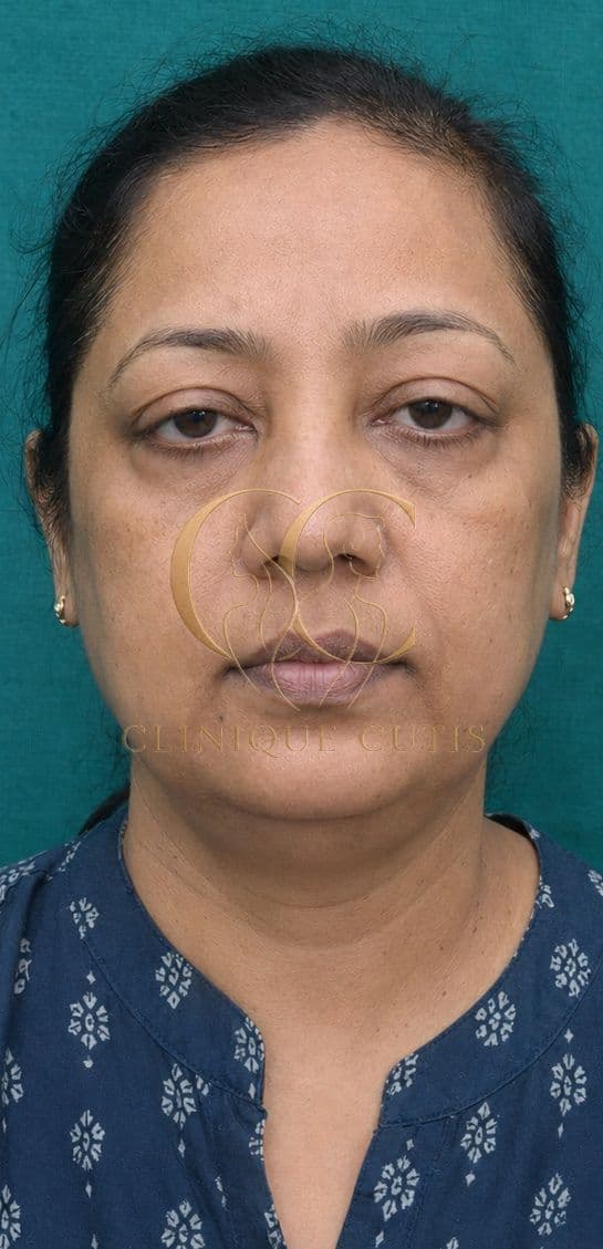 Upper Blepharoplasty Before